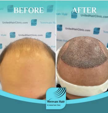 Slider image (2) United Hair Clinic